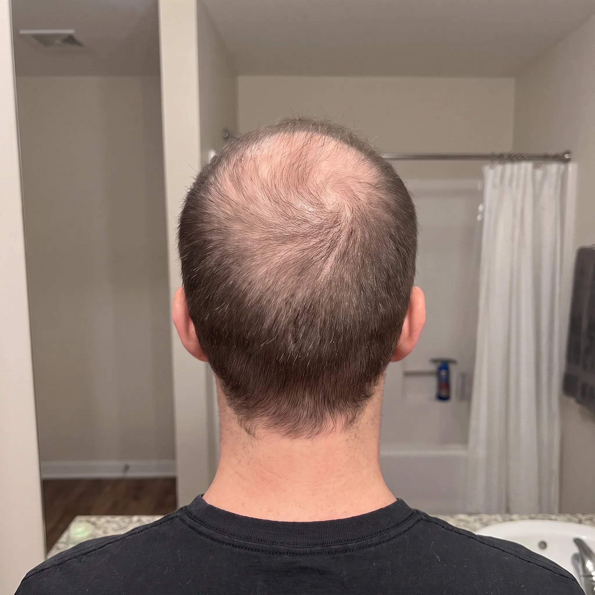 Man showing thinning hair at crown, back view in bathroom, before hair growth treatment